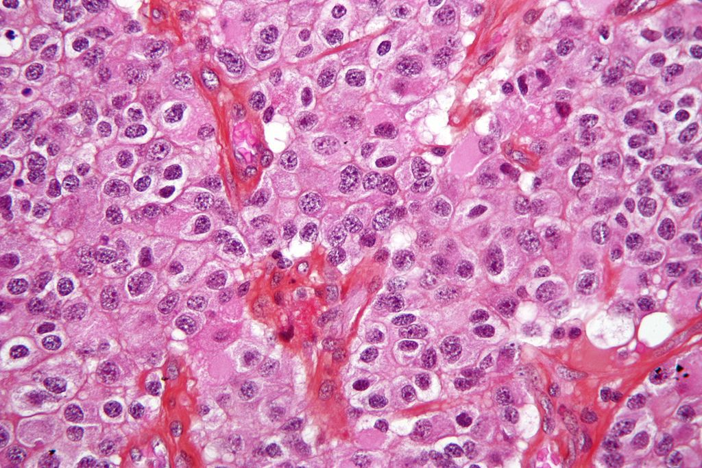 seizure reveals oligodendroglioma